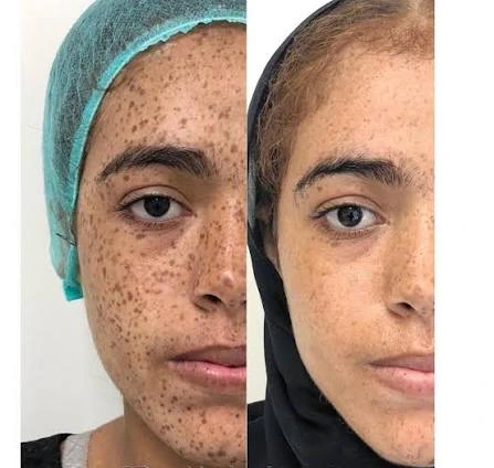 Laser and Pigmentation Treatment for Facial Freckles in Raebareli
