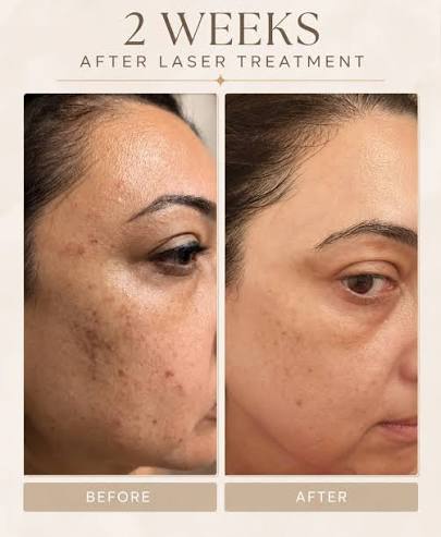 Advanced Pigmentation Correction Treatment for Hypermelanosis in Raebareli