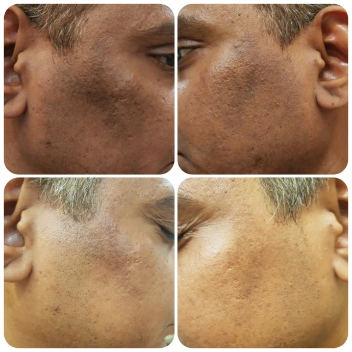 Dark Spot and PIH Treatment for Clearer Skin in Raebareli
