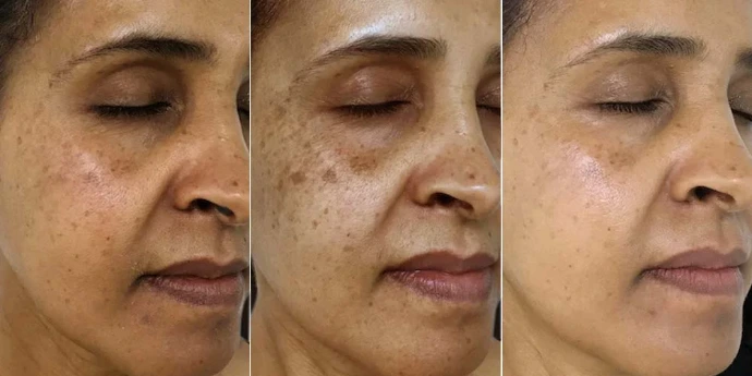 Melasma Treatment Before and After Results at Korean Skin Clinic Raebareli