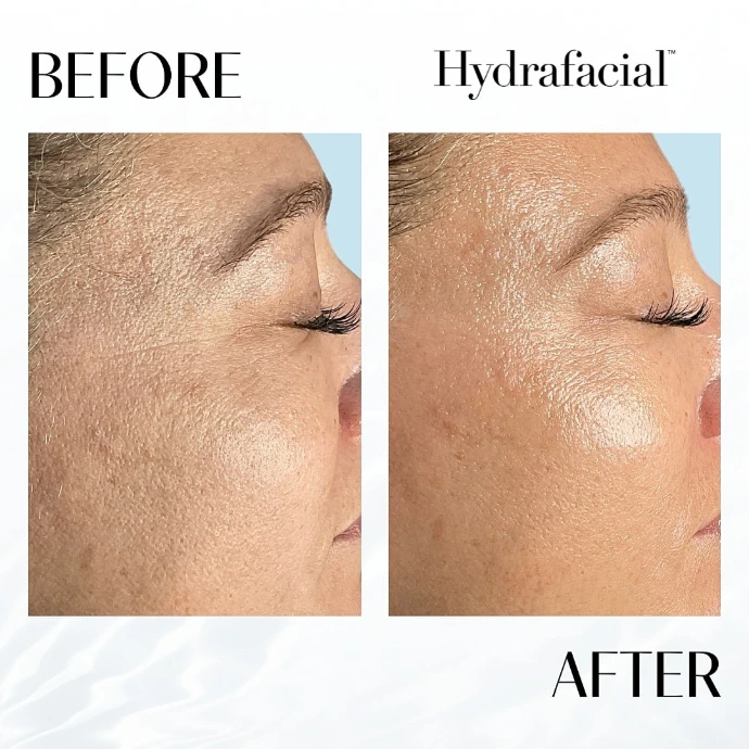 Deep Cleansing HydraFacial for Glowing and Hydrated Skin in Raebareli