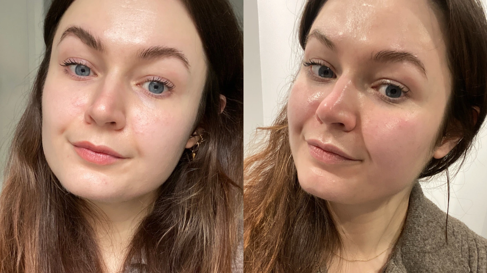 Instant Glow HydraFacial Before and After Results for Healthy Skin in Raebareli