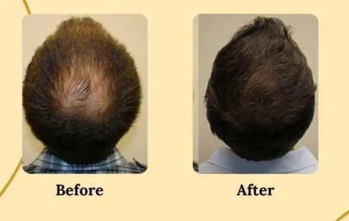 Hair growth improvement after regenerative hair treatment