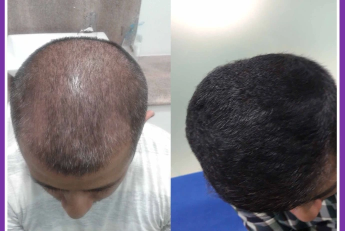 PRP vs GFC Hair Treatment comparison in Raebareli