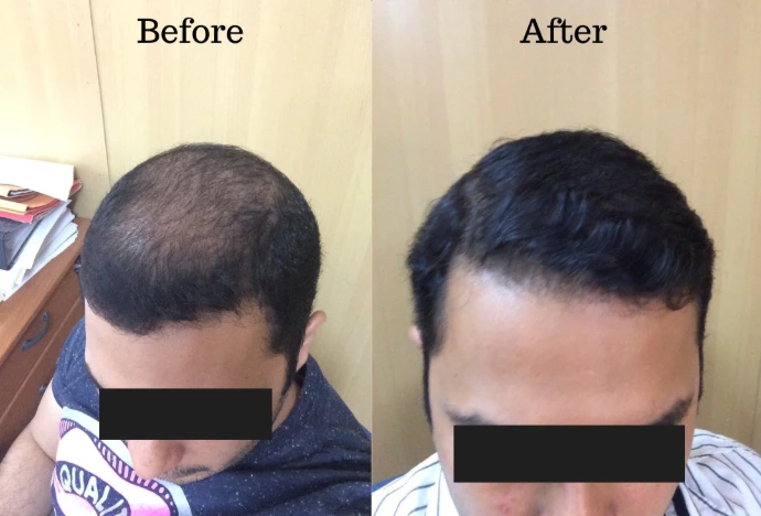 Doctor explaining PRP and GFC hair treatment options