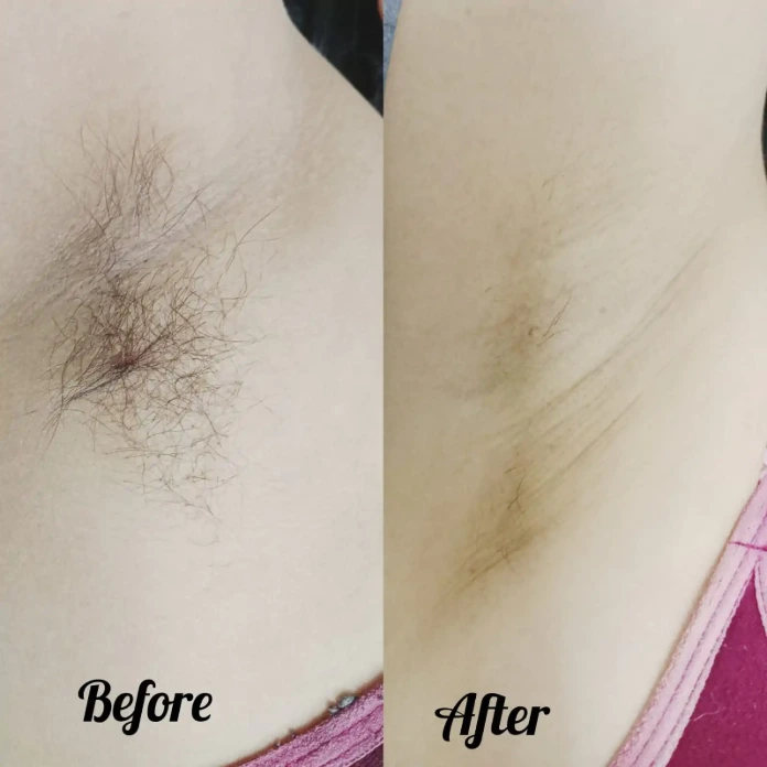 Before and after laser hair removal results at Korean Skin Clinic Raebareli