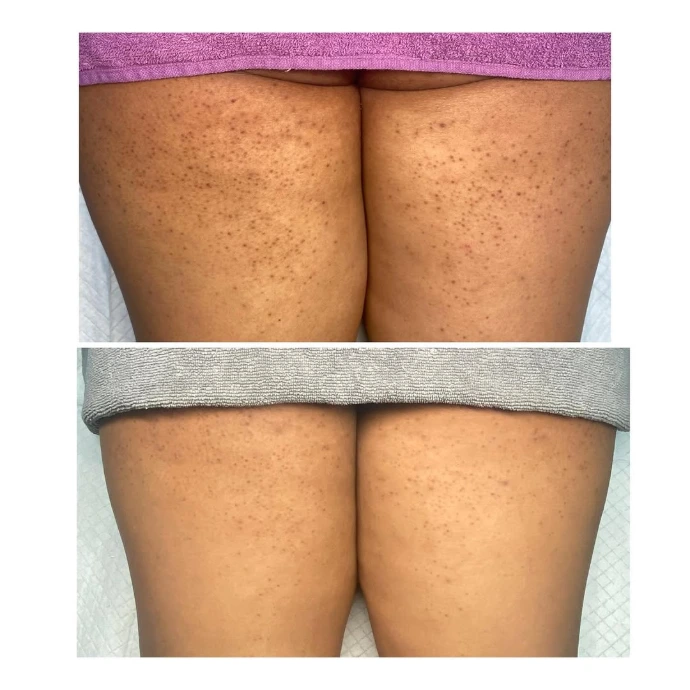 Before and after laser hair removal results at Korean Skin Clinic Raebareli