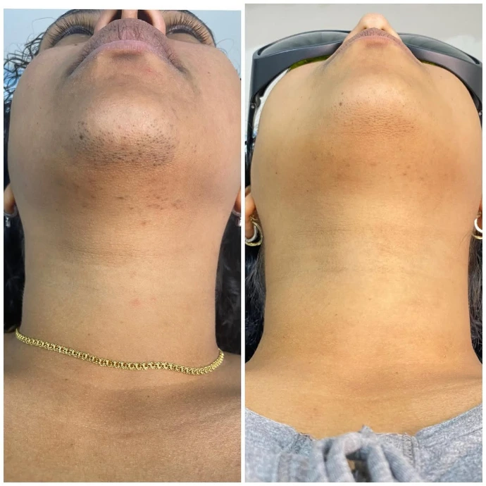 Before and after laser hair removal results at Korean Skin Clinic Raebareli