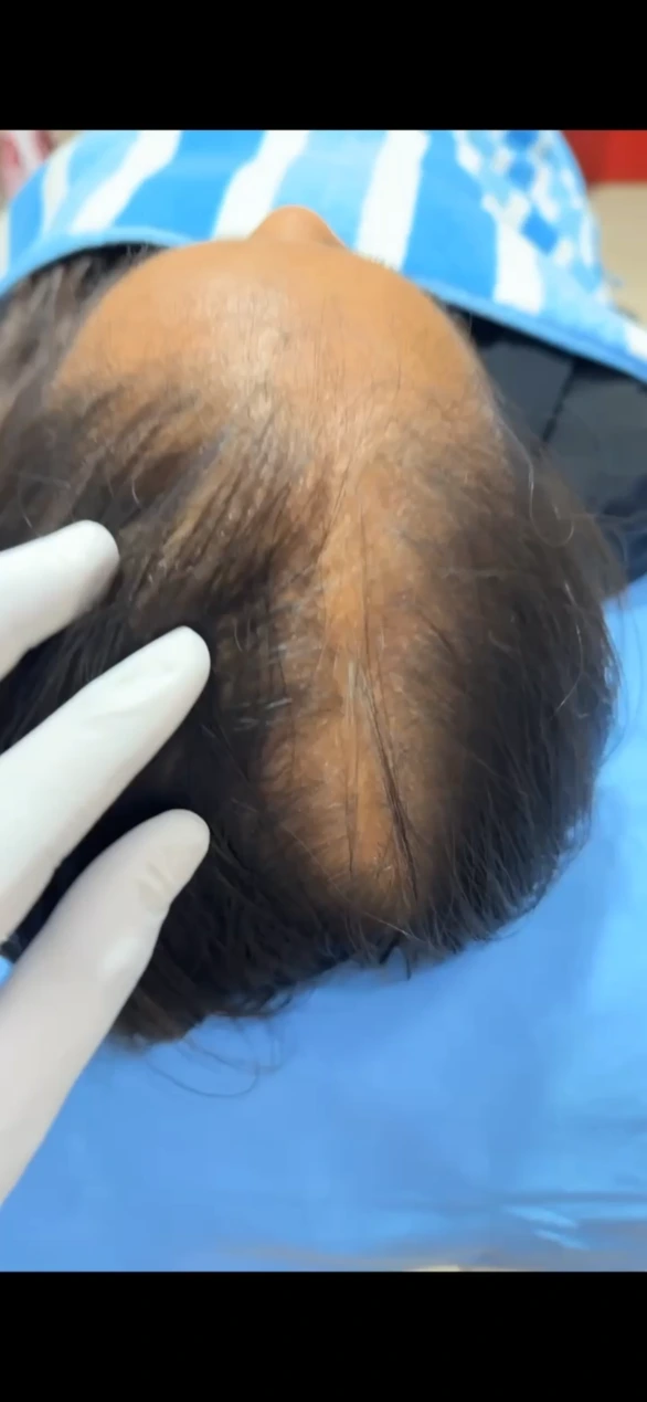 Dr Usama Siddiqui performing scalp analysis