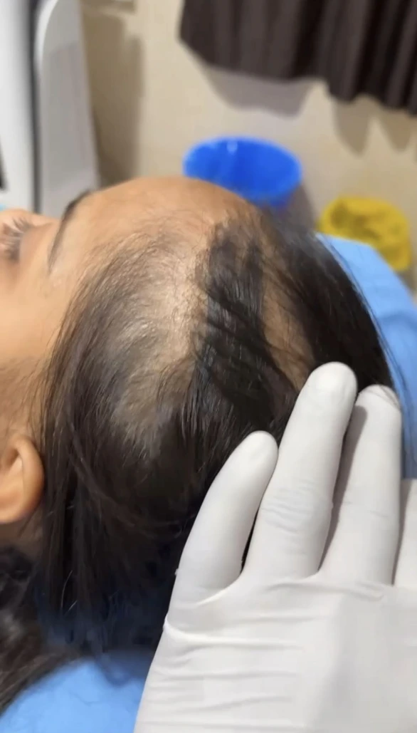 Dr Usama Siddiqui performing scalp analysis
