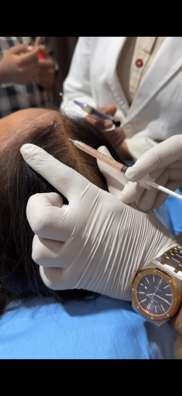 PRP and GFC hair treatment for women