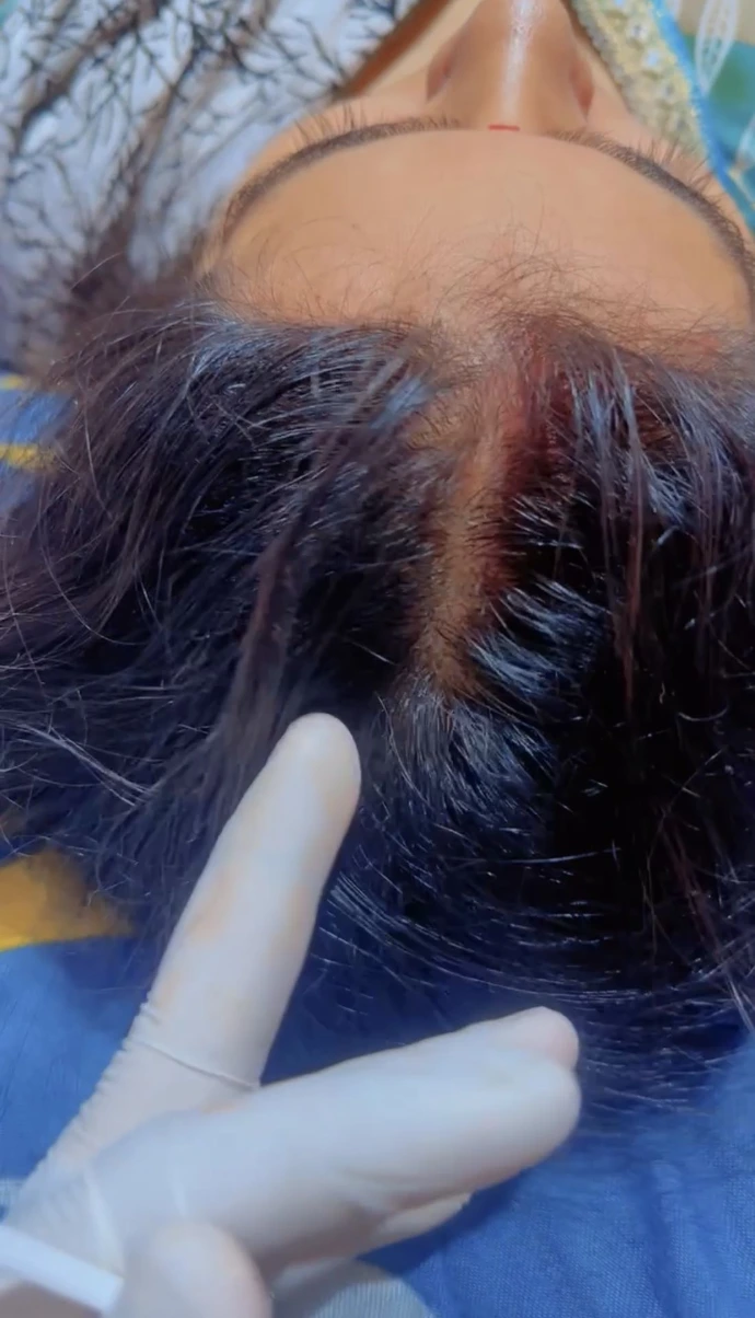 Hair thinning in women due to PCOS
