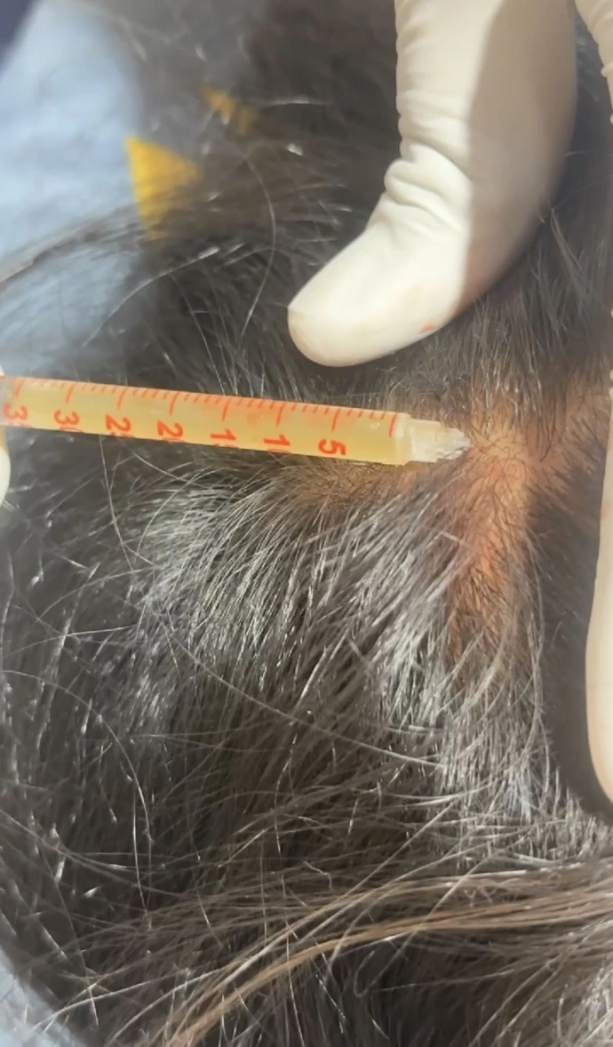 PRP and GFC hair treatment for women