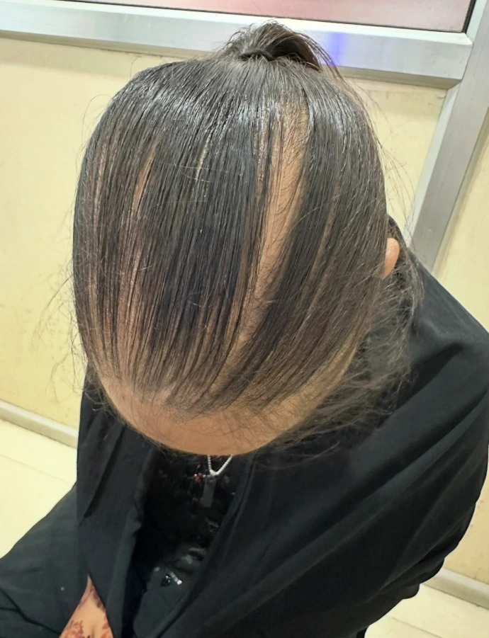 Female pattern hair loss stages
