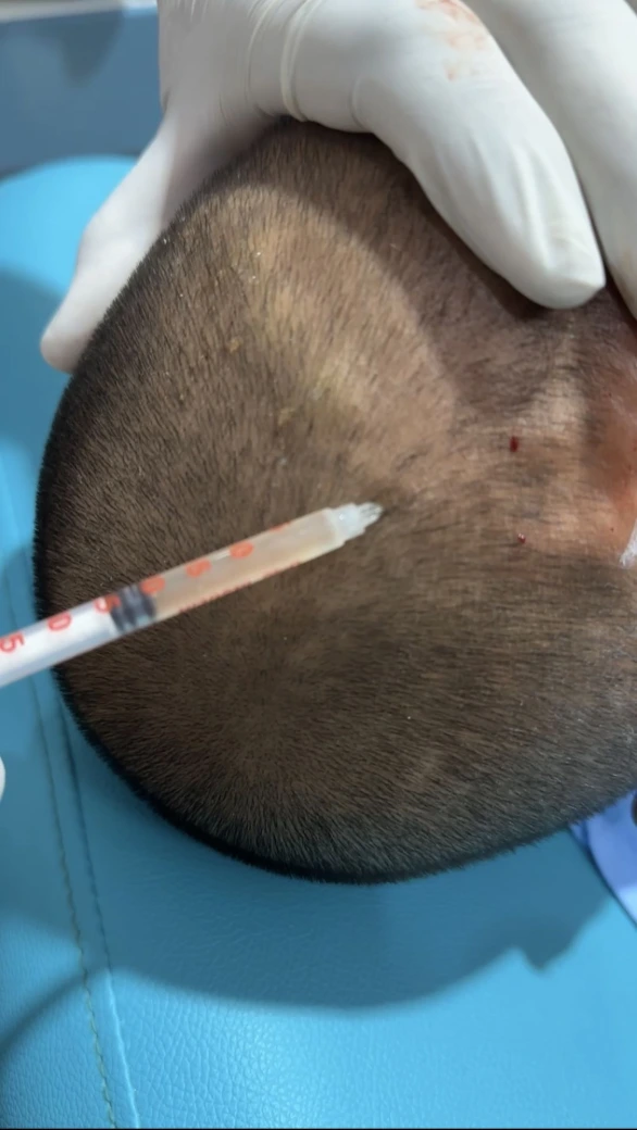 PRP Hair Treatment comparison in Raebareli by Dr Usama Siddiqui