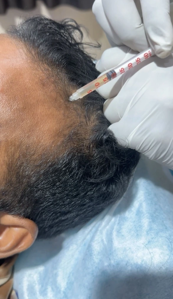 Hair growth improvement after regenerative hair treatment