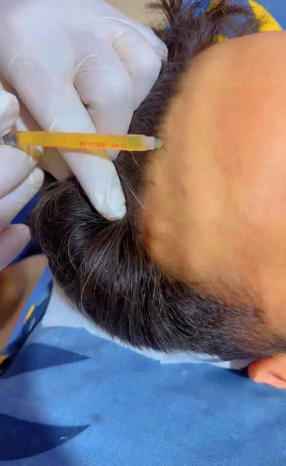 GFC Hair Treatment comparison in Raebareli by Dr Usama Siddiqui
