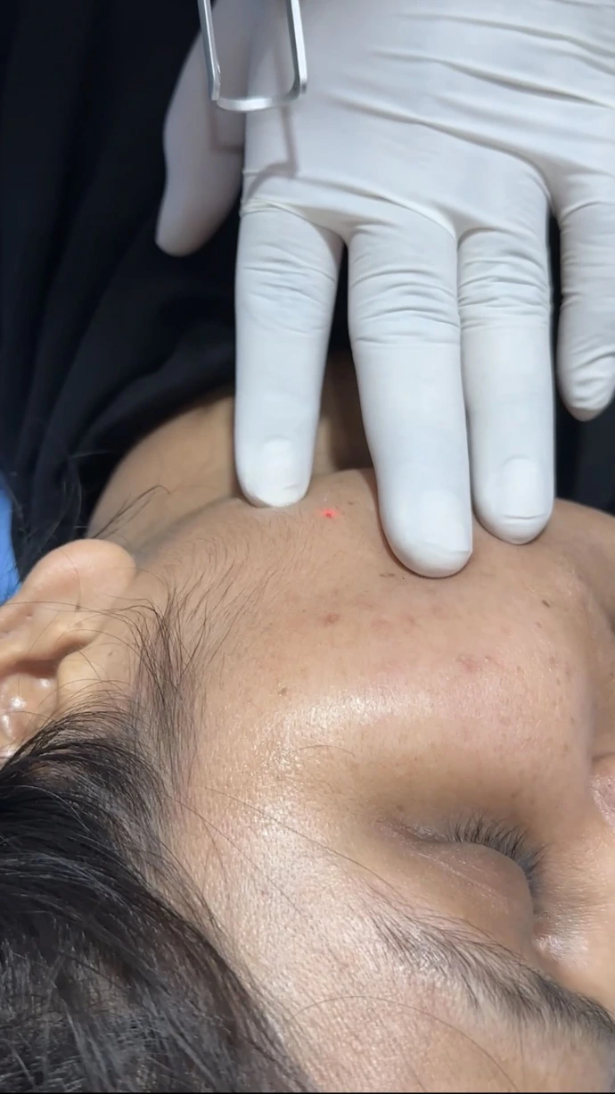Lasertreatment for acne scars by Dr Usama Siddiqui