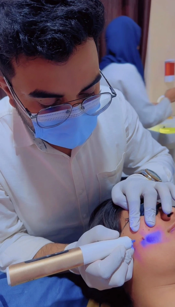 Cautery Laser Treatment by Dr Usama Siddiqui