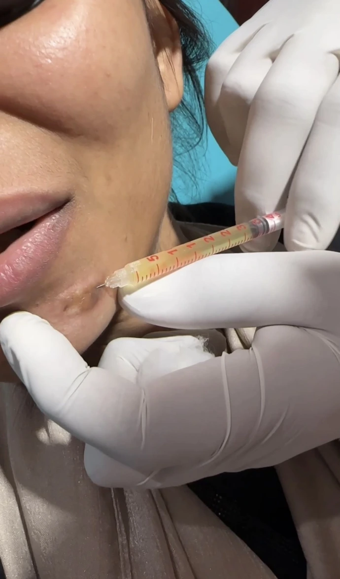 PRP treatment for acne scars by Dr Usama Siddiqui