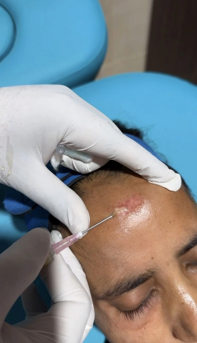 Types of acne scars including ice pick boxcar and rolling scars