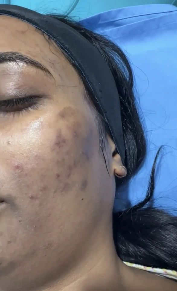 Acne Pigmentation Treatment by Dr Usama Siddiqui