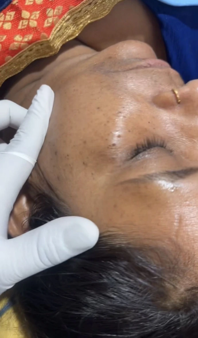 Before and after acne scar treatment results