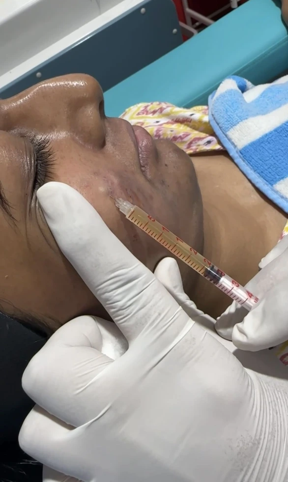 GFC Treatment for Melasma