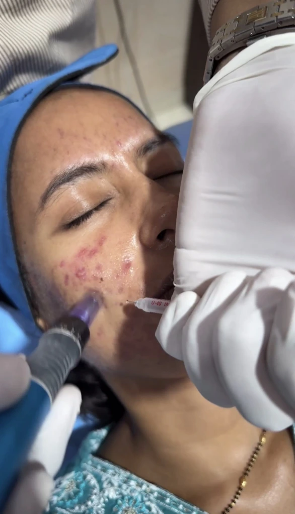 Before and after melasma treatment results