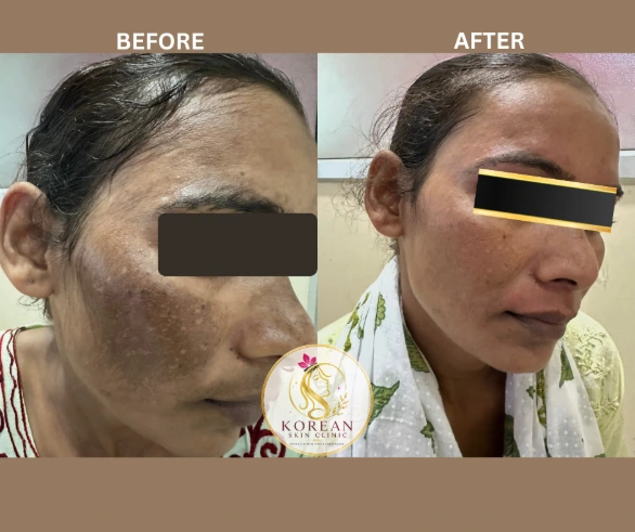 Melasma on cheeks and forehead before treatment