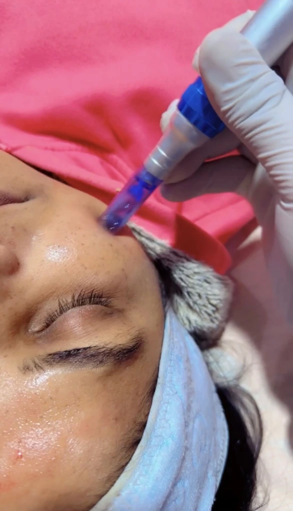 Chemical peel treatment for melasma