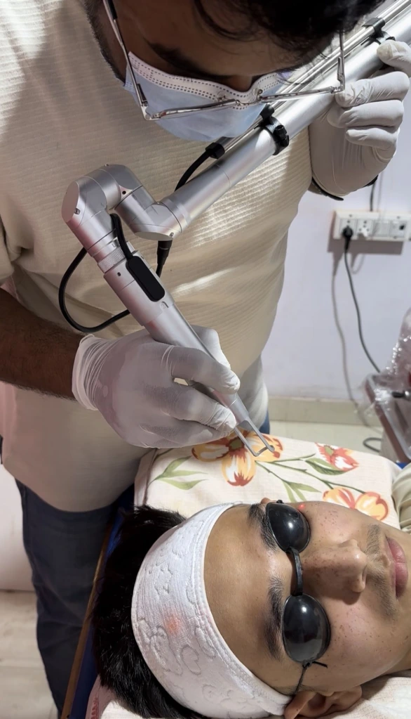Carbon laser peel for pigmentation treatment